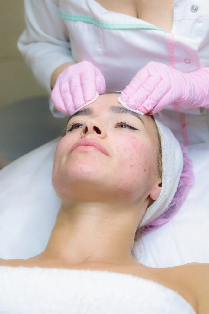 vanestética tratamiento eliminacion de manchas faciales en collado villalba